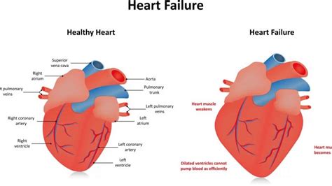 mild global lv hypokinesia|severe global hypokinesis life expectancy.